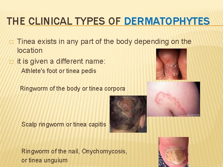 THE CLINICAL TYPES OF DERMATOPHYTES � � Tinea exists in any part of the