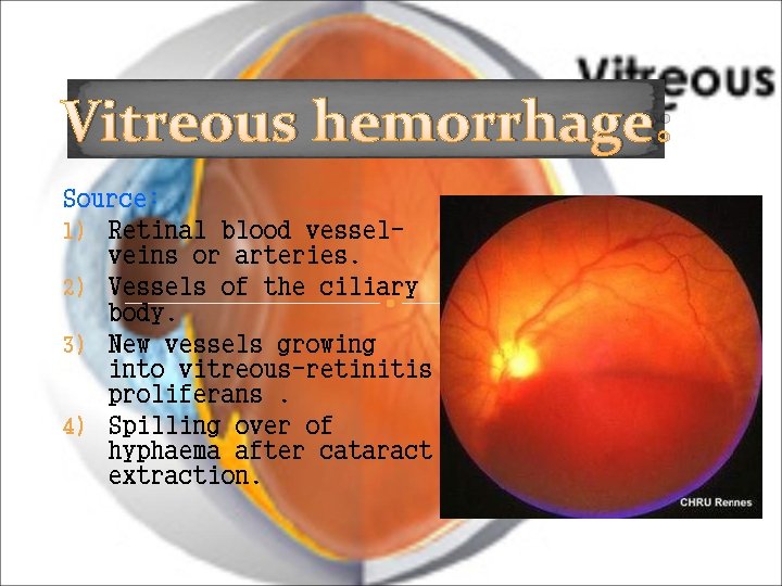 Vitreous hemorrhage: Source: 1) Retinal blood vesselveins or arteries. 2) Vessels of the ciliary Vitreous hemorrhage: Source: 1) Retinal blood vesselveins or arteries. 2) Vessels of the ciliary