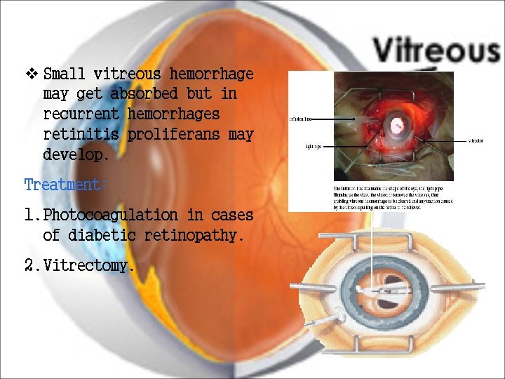 v Small vitreous hemorrhage may get absorbed but in recurrent hemorrhages retinitis proliferans may v Small vitreous hemorrhage may get absorbed but in recurrent hemorrhages retinitis proliferans may