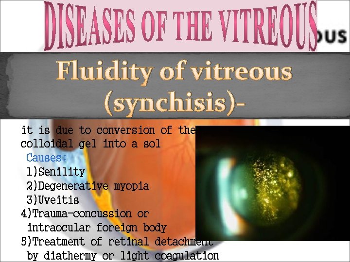 Fluidity of vitreous (synchisis)it is due to conversion of the colloidal gel into a Fluidity of vitreous (synchisis)it is due to conversion of the colloidal gel into a