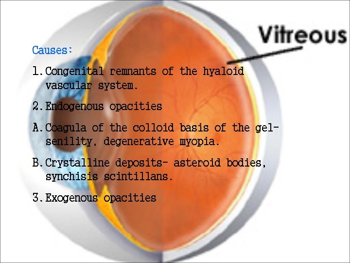 Causes: 1. Congenital remnants of the hyaloid vascular system. 2. Endogenous opacities A. Coagula Causes: 1. Congenital remnants of the hyaloid vascular system. 2. Endogenous opacities A. Coagula
