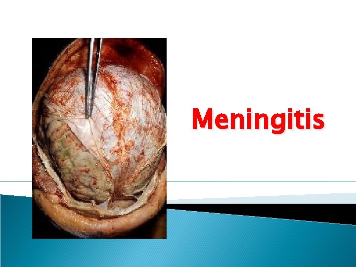 Meningitis 