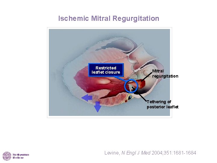 Ischemic Mitral Regurgitation Restricted leaflet closure Mitral regurgitation Tethering of posterior leaflet Levine, N