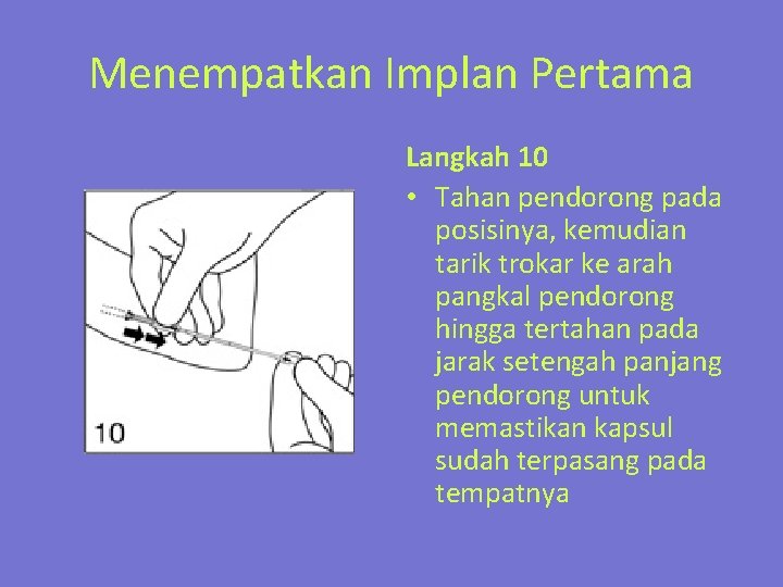 Menempatkan Implan Pertama Langkah 10 • Tahan pendorong pada posisinya, kemudian tarik trokar ke