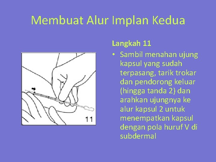 Membuat Alur Implan Kedua Langkah 11 • Sambil menahan ujung kapsul yang sudah terpasang,