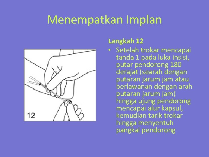 Menempatkan Implan Langkah 12 • Setelah trokar mencapai tanda 1 pada luka insisi, putar