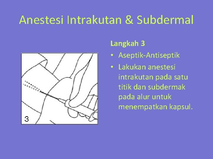 Anestesi Intrakutan & Subdermal Langkah 3 • Aseptik-Antiseptik • Lakukan anestesi intrakutan pada satu