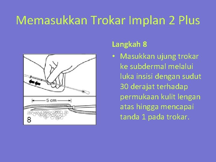 Memasukkan Trokar Implan 2 Plus Langkah 8 • Masukkan ujung trokar ke subdermal melalui