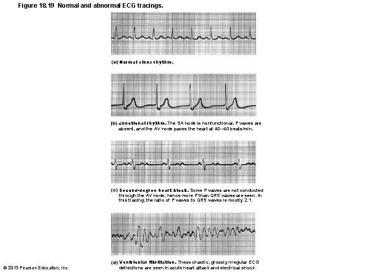 Figure 18. 19 Normal and abnormal ECG tracings. Normal sinus rhythm. Junctional rhythm. The