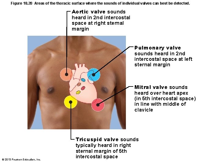 Figure 18. 20 Areas of the thoracic surface where the sounds of individual valves