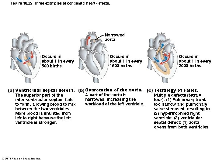 Figure 18. 25 Three examples of congenital heart defects. Narrowed aorta Occurs in about