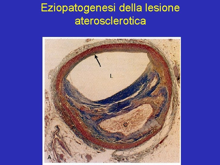 Eziopatogenesi della lesione aterosclerotica 