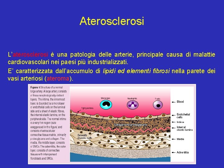 Aterosclerosi L’aterosclerosi è una patologia delle arterie, principale causa di malattie cardiovascolari nei paesi