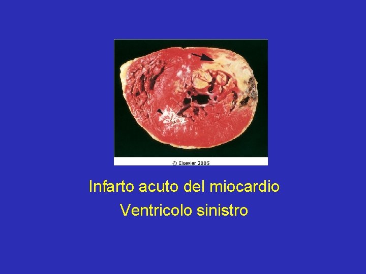 Infarto acuto del miocardio Ventricolo sinistro 