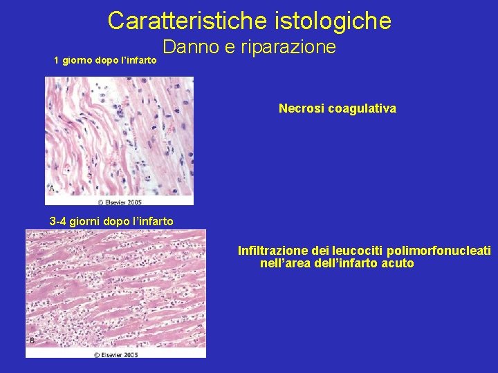 Caratteristiche istologiche 1 giorno dopo l’infarto Danno e riparazione Necrosi coagulativa 3 -4 giorni