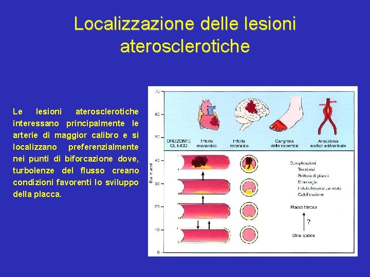 Localizzazione delle lesioni aterosclerotiche Le lesioni aterosclerotiche interessano principalmente le arterie di maggior calibro