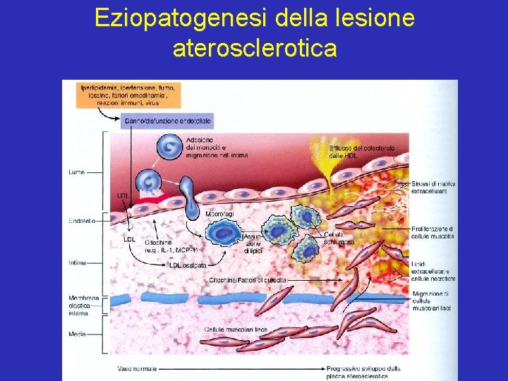 Eziopatogenesi della lesione aterosclerotica 