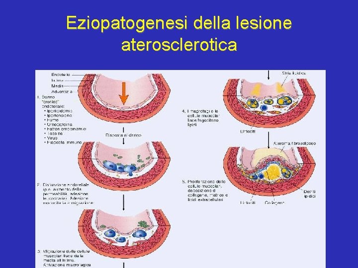 Eziopatogenesi della lesione aterosclerotica 