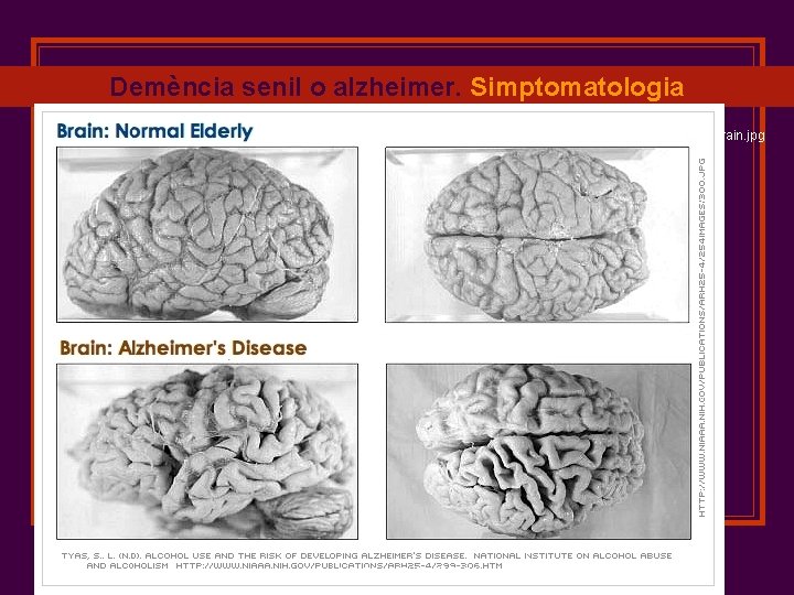 Demència senil o alzheimer. Simptomatologia http: //web. lemoyne. edu/~hevern/psy 340/graphics/alzheimer. normal. brain. jpg RICARD