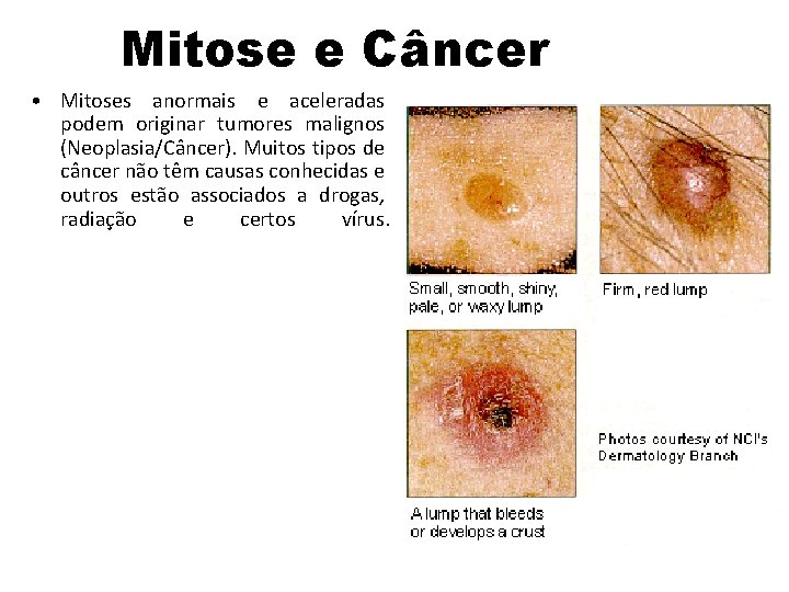 Mitose e Câncer • Mitoses anormais e aceleradas podem originar tumores malignos (Neoplasia/Câncer). Muitos