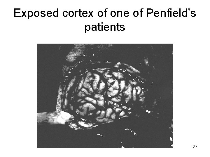 Exposed cortex of one of Penfield’s patients 27 Exposed cortex of one of Penfield’s patients 27