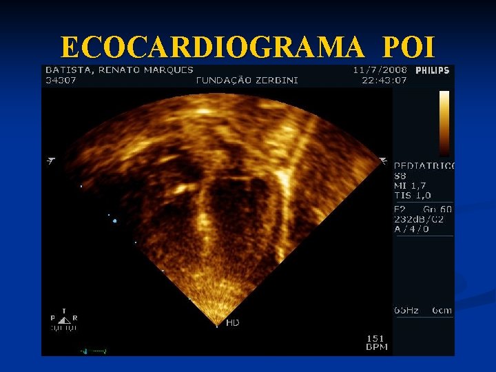 ECOCARDIOGRAMA POI 