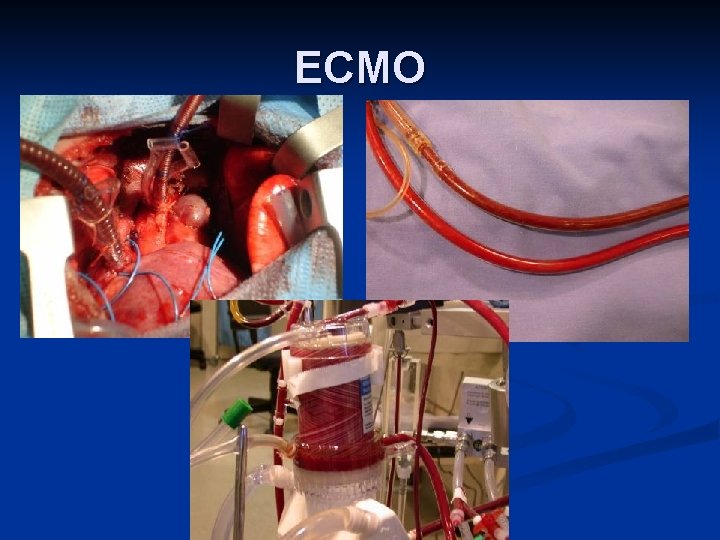 ECMO 