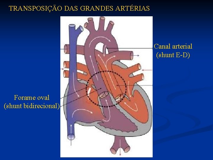 TRANSPOSIÇÃO DAS GRANDES ARTÉRIAS Canal arterial (shunt E-D) Forame oval (shunt bidirecional) 