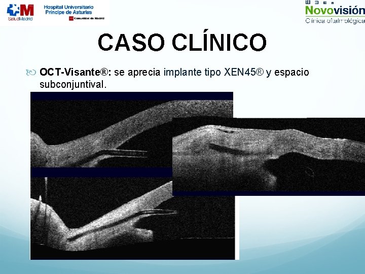 CASO CLÍNICO OCT-Visante®: se aprecia implante tipo XEN 45® y espacio subconjuntival. 