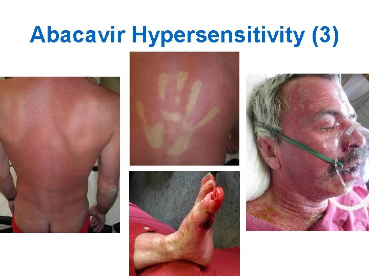 Abacavir Hypersensitivity (3) 