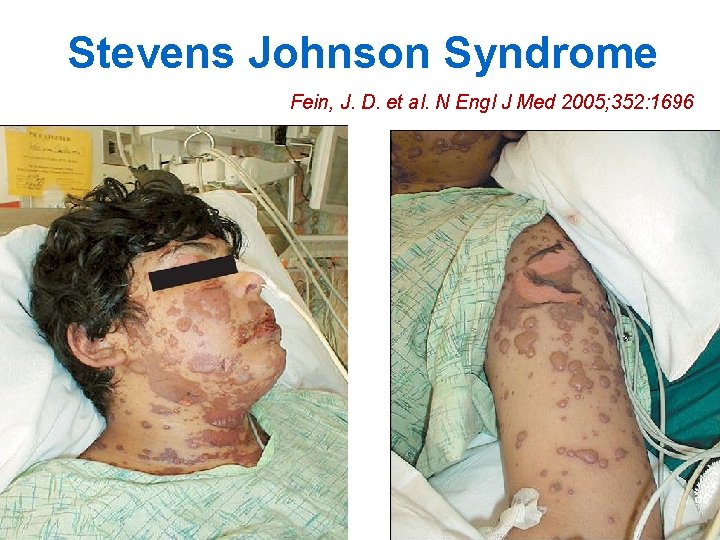 Stevens Johnson Syndrome Fein, J. D. et al. N Engl J Med 2005; 352: