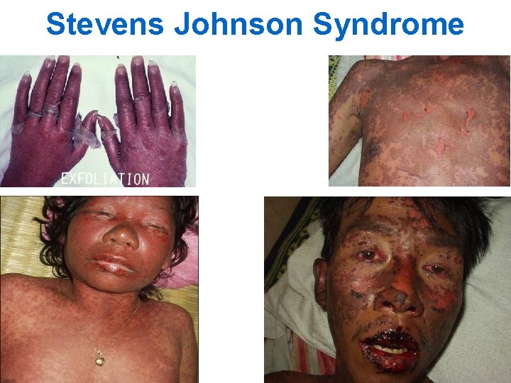 Stevens Johnson Syndrome 