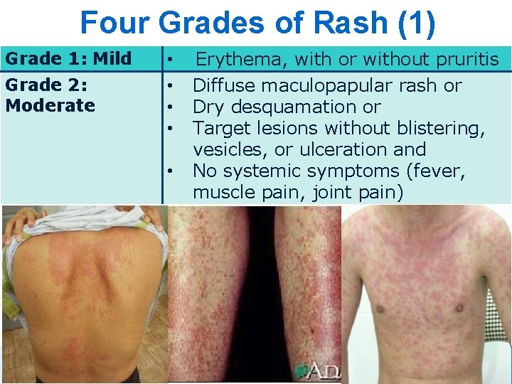 Four Grades of Rash (1) Grade 1: Mild Grade 2: Moderate • • •