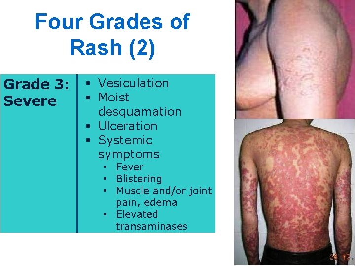 Four Grades of Rash (2) Grade 3: Severe § Vesiculation § Moist desquamation §