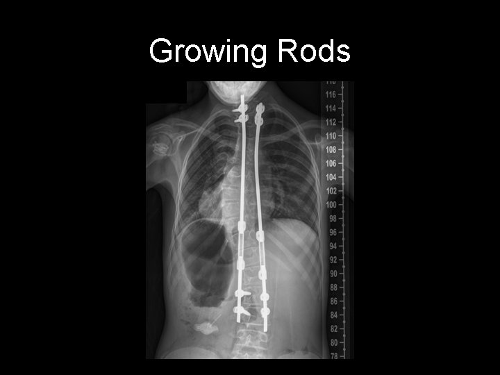 Growing Rods 