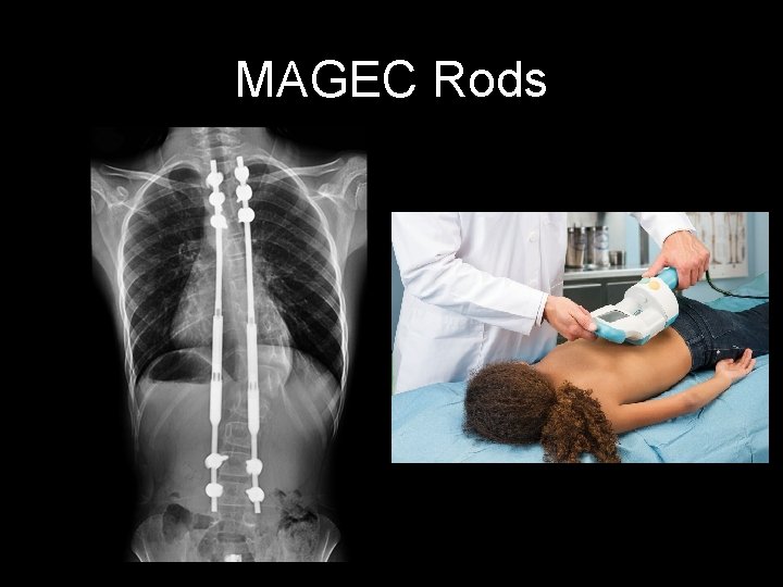 MAGEC Rods 