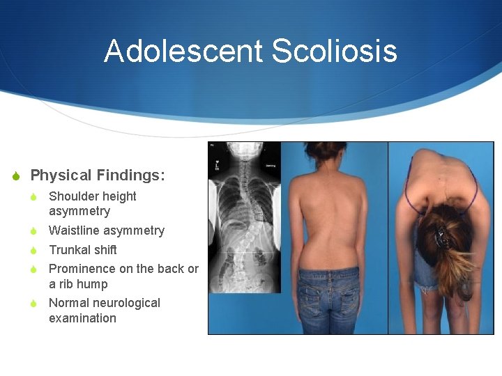 Adolescent Scoliosis S Physical Findings: S Shoulder height asymmetry S Waistline asymmetry S Trunkal