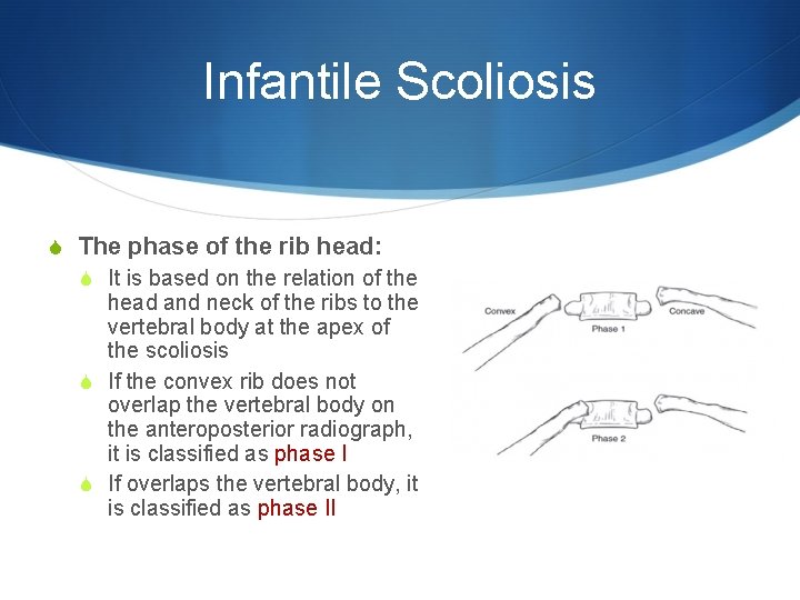 Infantile Scoliosis S The phase of the rib head: S It is based on