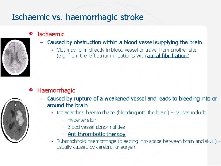 Ischaemic vs. haemorrhagic stroke Ischaemic – Caused by obstruction within a blood vessel supplying