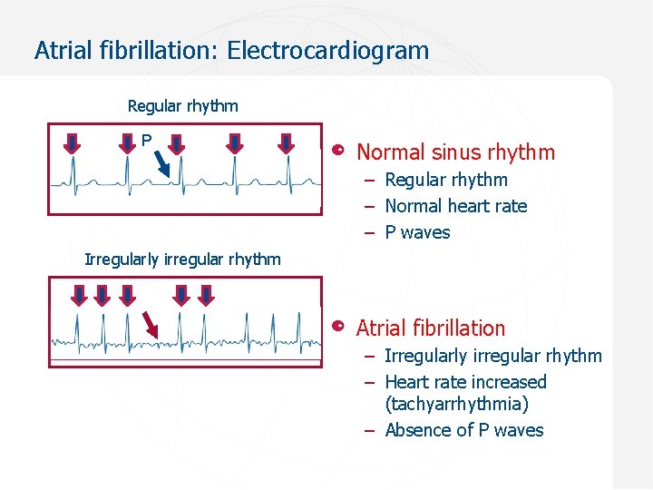 Atrial fibrillation: Electrocardiogram Regular rhythm P Normal sinus rhythm – Regular rhythm – Normal