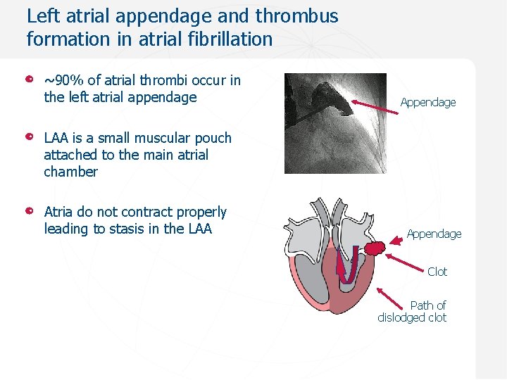 Left atrial appendage and thrombus formation in atrial fibrillation ~90% of atrial thrombi occur