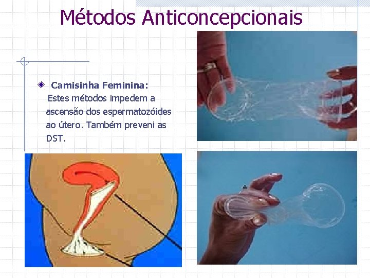  Métodos Anticoncepcionais Camisinha Feminina: Estes métodos impedem a ascensão dos espermatozóides ao útero.