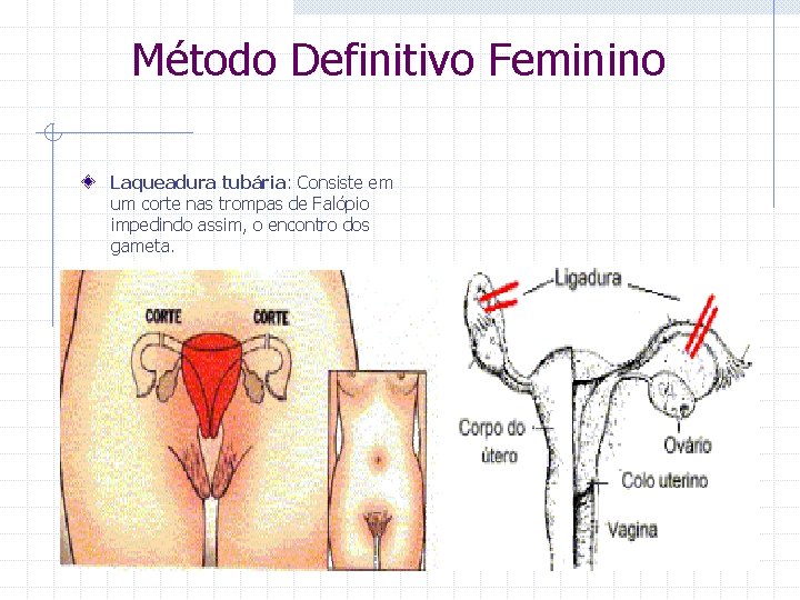  Método Definitivo Feminino Laqueadura tubária: Consiste em um corte nas trompas de Falópio