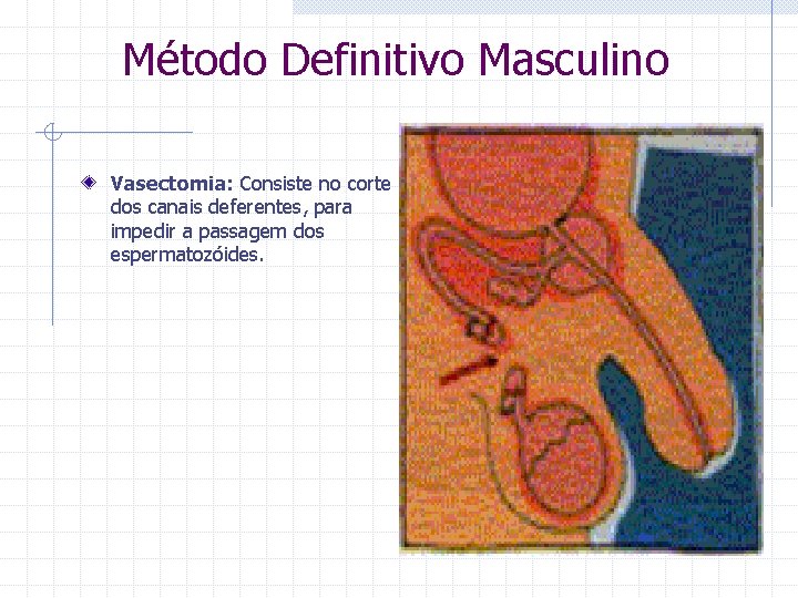  Método Definitivo Masculino Vasectomia: Consiste no corte dos canais deferentes, para impedir a