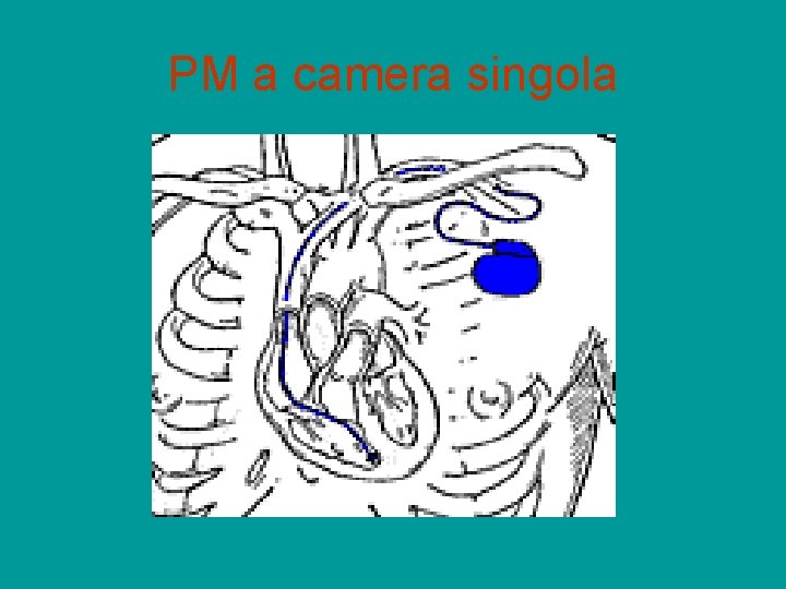 PM a camera singola 