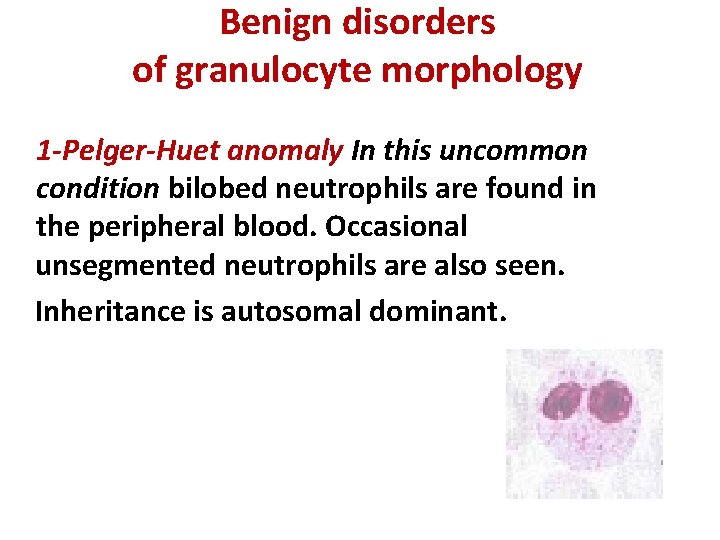 Benign disorders of granulocyte morphology 1 -Pelger-Huet anomaly In this uncommon condition bilobed neutrophils Benign disorders of granulocyte morphology 1 -Pelger-Huet anomaly In this uncommon condition bilobed neutrophils