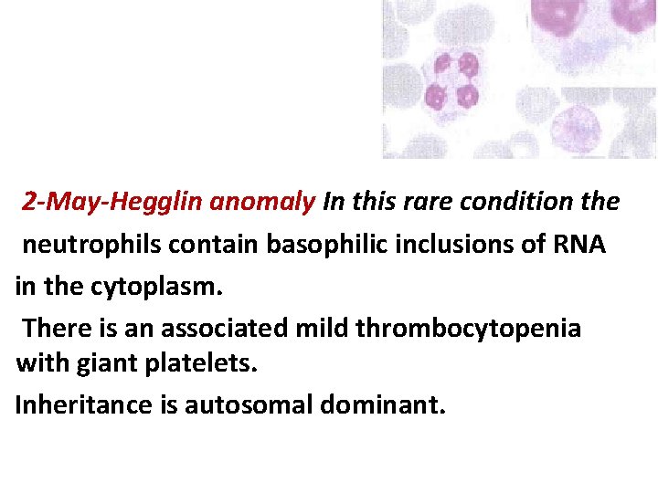 2 -May-Hegglin anomaly In this rare condition the neutrophils contain basophilic inclusions of RNA 2 -May-Hegglin anomaly In this rare condition the neutrophils contain basophilic inclusions of RNA
