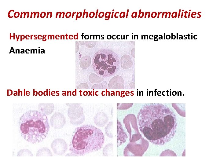 Common morphological abnormalities Hypersegmented forms occur in megaloblastic Anaemia Dahle bodies and toxic changes Common morphological abnormalities Hypersegmented forms occur in megaloblastic Anaemia Dahle bodies and toxic changes
