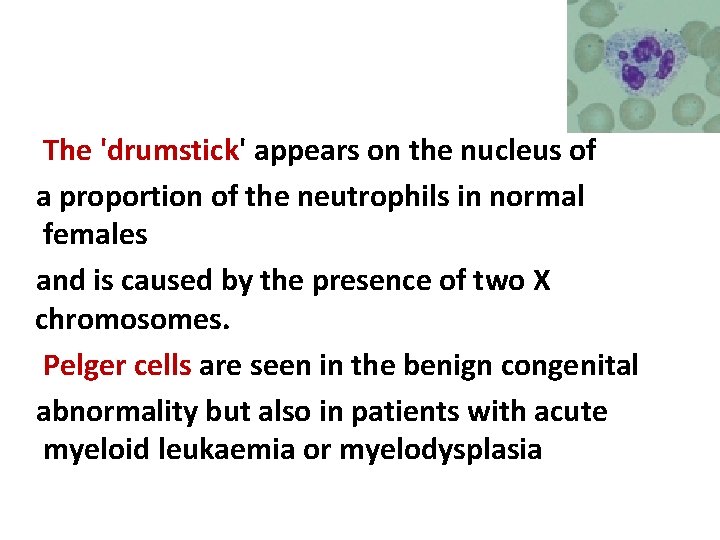 The 'drumstick' appears on the nucleus of a proportion of the neutrophils in normal The 'drumstick' appears on the nucleus of a proportion of the neutrophils in normal