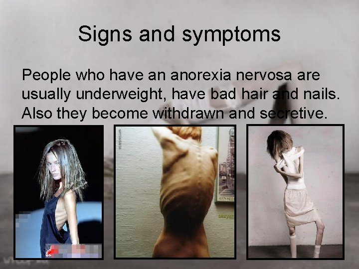 Signs and symptoms People who have an anorexia nervosa are usually underweight, have bad